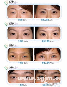 割眼皮可改運?