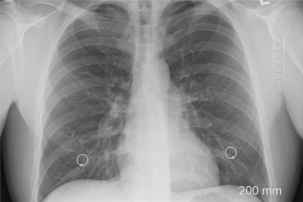 夢到了肺結核是凶兆還是吉兆_周公解夢