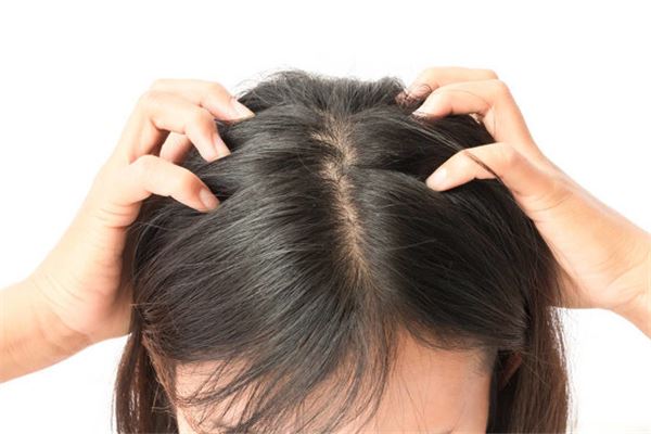 夢見頭皮屑_周公解夢