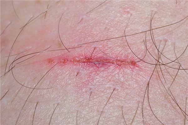 夢見自己被砍傷_周公解夢