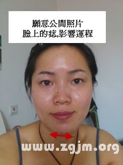 夫妻宮有黑痣